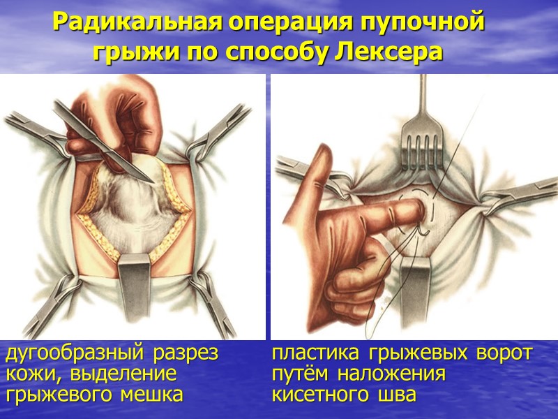 Радикальная операция пупочной грыжи по способу Лексера дугообразный разрез кожи, выделение грыжевого мешка 